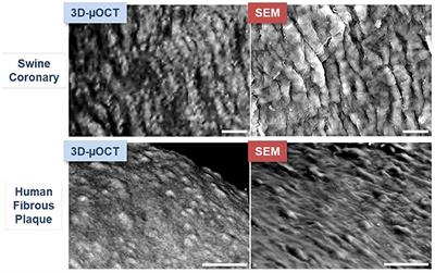 Micro Optical Coherence Tomography for Coronary Imaging